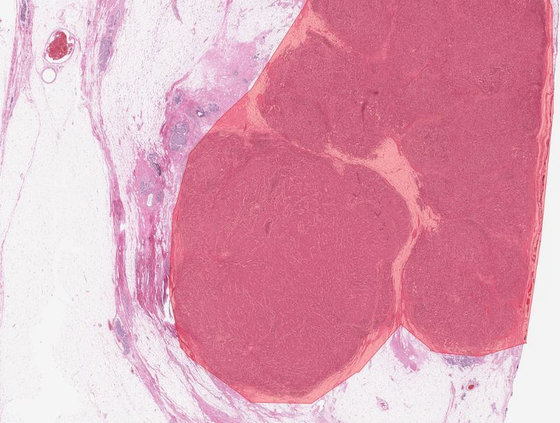 DeepBio's DeepDx Brast - SLNB is available in PathFlow.