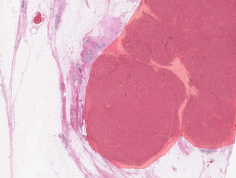 slide of DeepDx® Breast – Resection