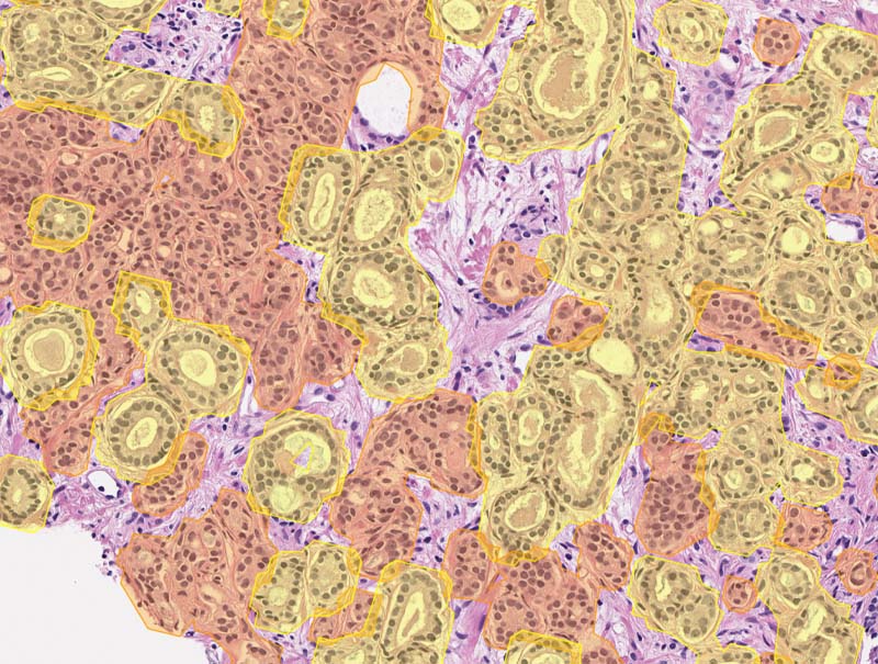 slide of DeepDx® Prostate – CNB