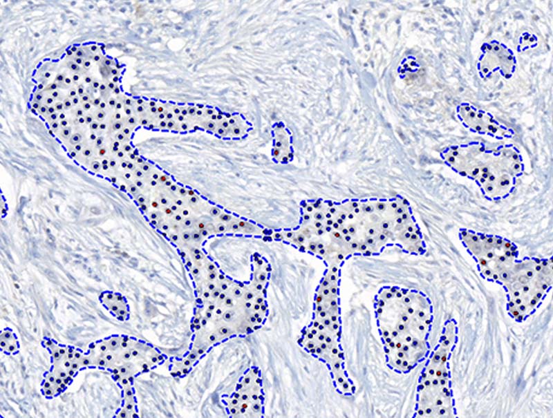 slide of ER APP, Breast Cancer