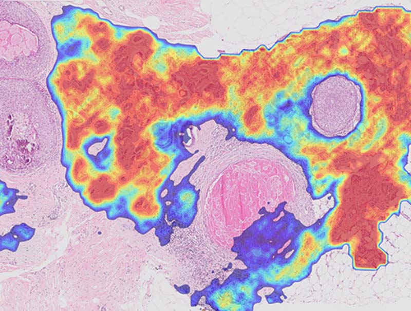 slide of Ibex Breast
