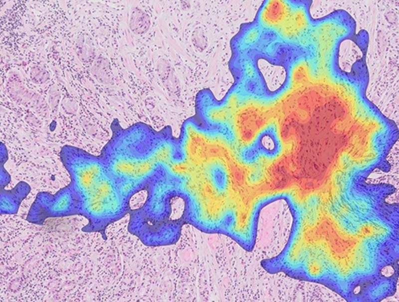 slide of Ibex Gastric