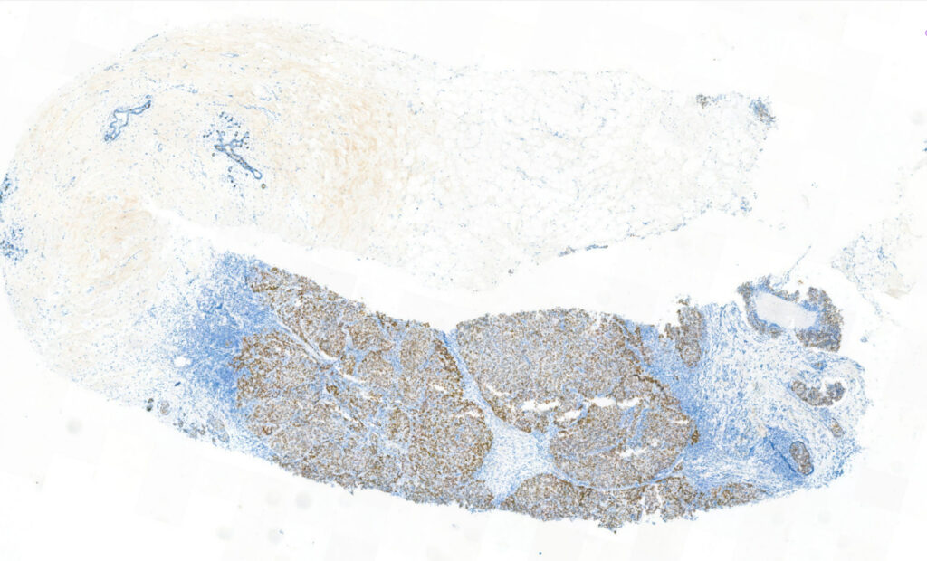 slide of Mindpeak Breast ER:PR