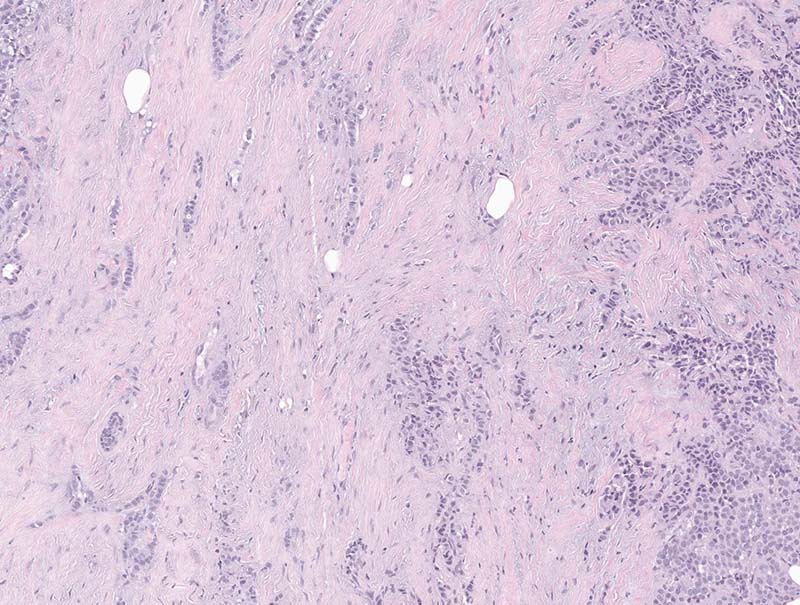 slide of Mindpeak Breast H&E