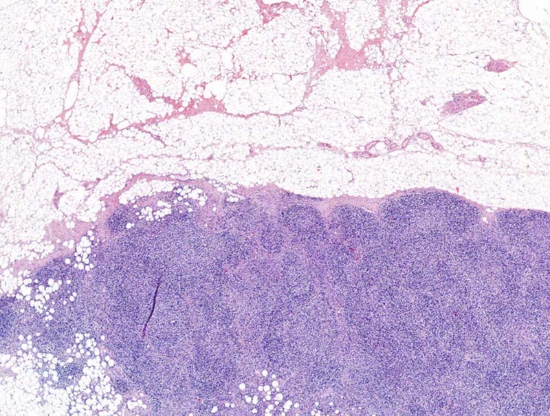 slide of Mindpeak Breast Metastasis Detection