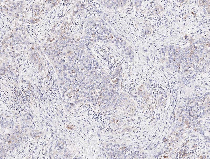 slide of Mindpeak Esophagus PD-L1