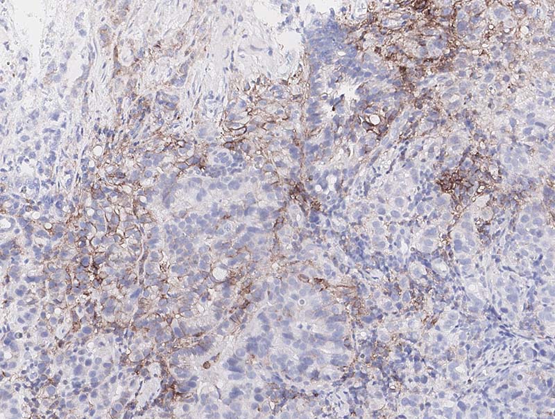 slide of Mindpeak Gastric PD-L1