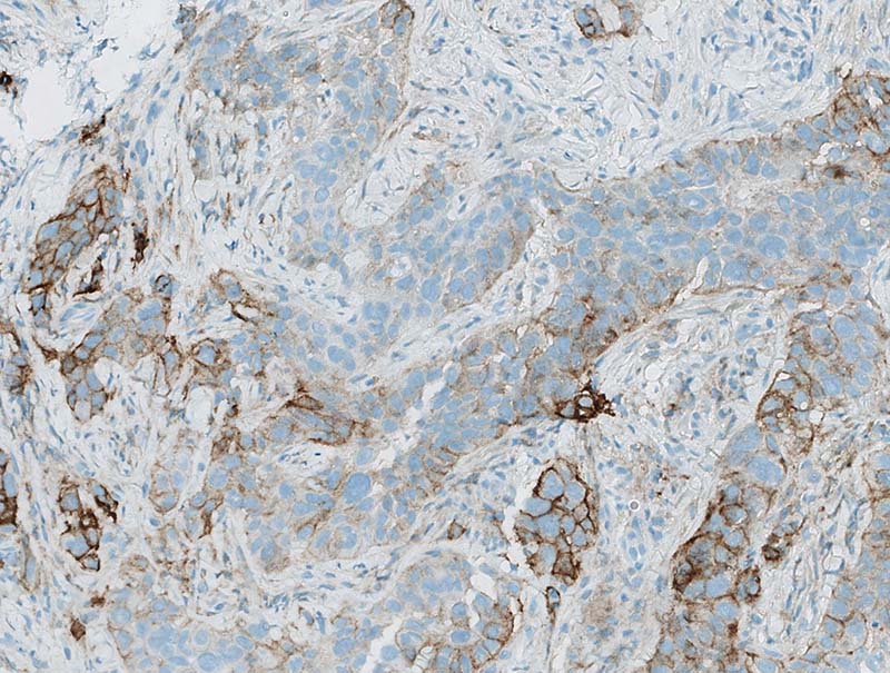 slide of Mindpeak Lung (NSCLC) PD-L1