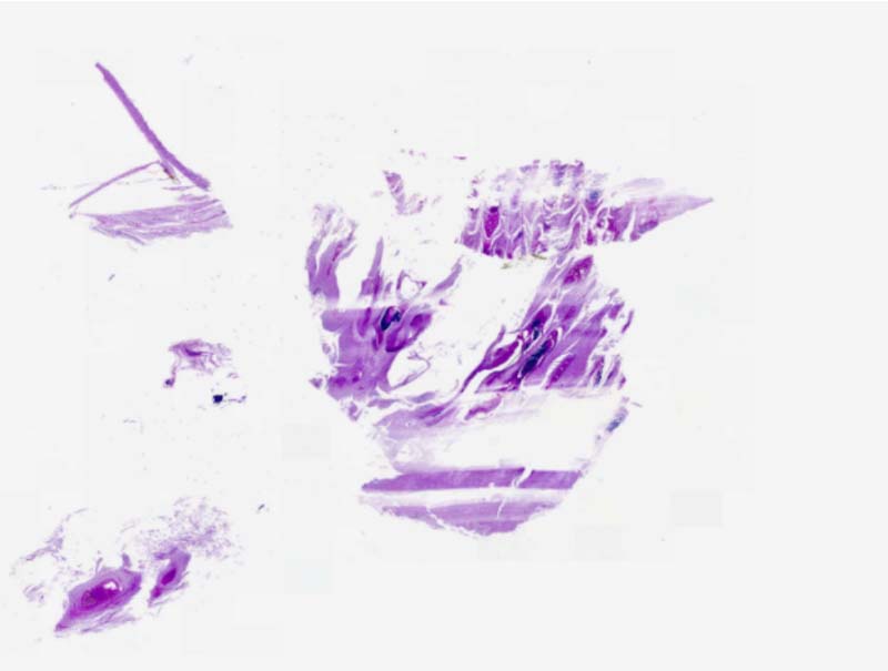 slide of Mindpeak Onychomycosis AI