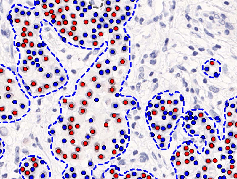 slide of PR APP, Breast Cancer