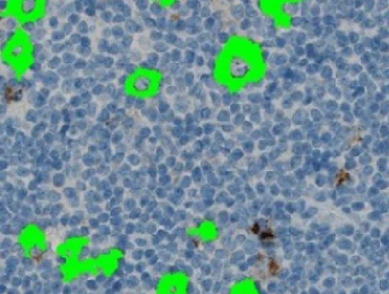 VisioPharm's CD15 Hodgkins Lymphoma is now available in Pathflow