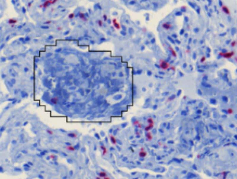 VisioPharm's CD3, Lung Transplantation is available in Pathflow