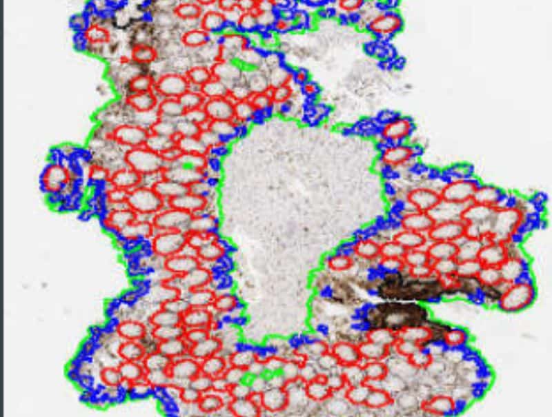 VisioPharm's CD3, Lymphocytic Colitis is available in Pathflow