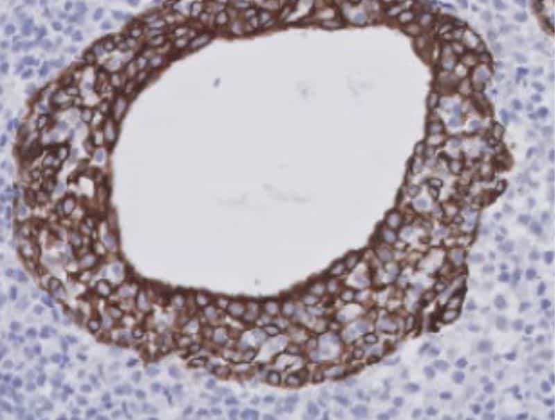 VisioPharm's CD3+CD20+CK, Sjögren’s Syndrome, is available in Pathflow