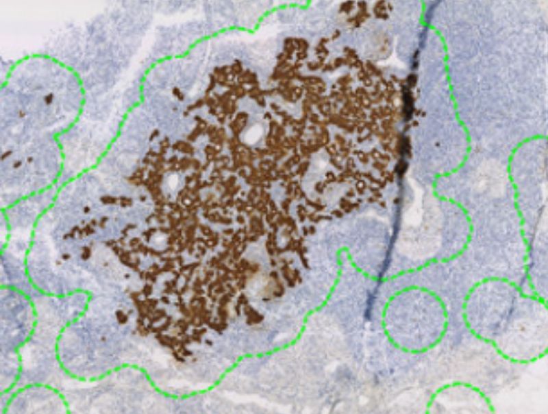 VisioPharm's, CK, Metastasis Detection is available in Pathflow