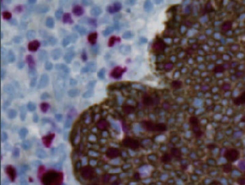 VisioPharm's, CK5+Ki-67, Neck Cancer is available in Pathflow