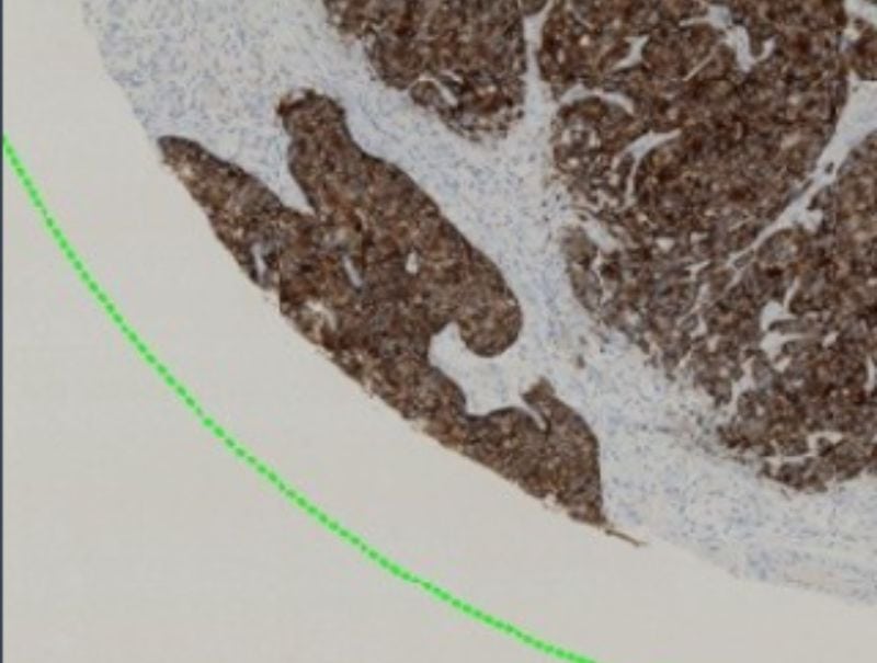 VisioPharm's CK8/18, Breast Cancer is available for Pathflow