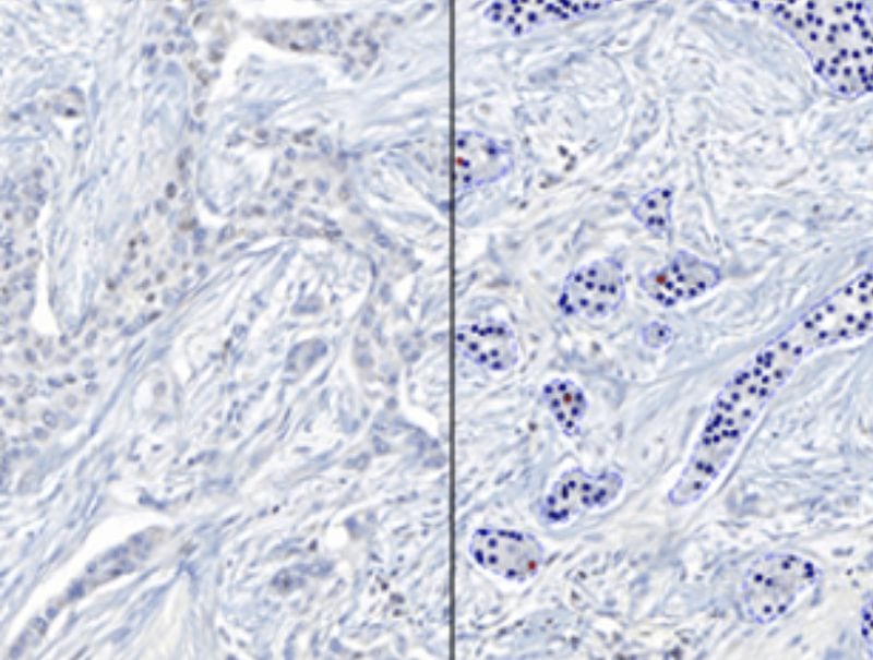 VisioPharm's ER, Breast Cancer, AI is available in Pathflow