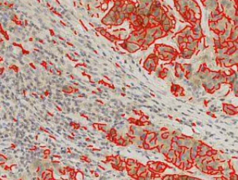 VisioPharm's Glut1, Breast/Colon/Lung Cancer is available in Pathflow