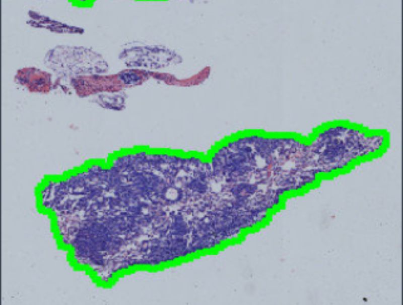 VisioPharm's H&E Lung Metastasis is available for Pathflow.