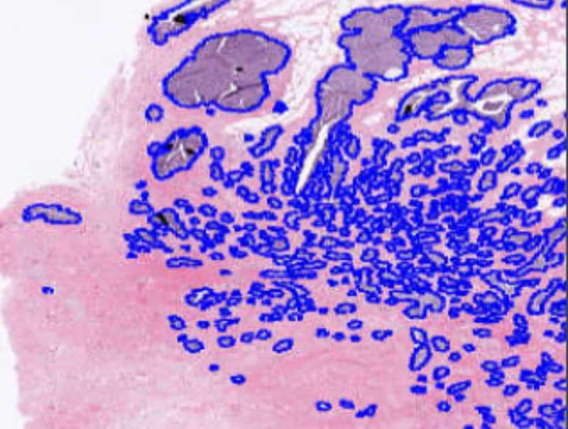 VisioPharm's H&E Tumor Load is available in Pathflow.