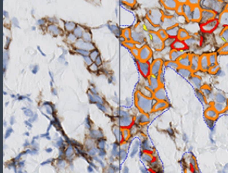 VisioPharm's HER2 APP, Breast Cancer is available in Pathflow