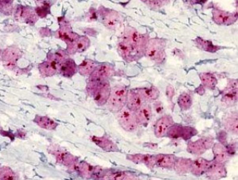 VisioPharm's HER2-CISH, Breast Cancer is available in Pathflow