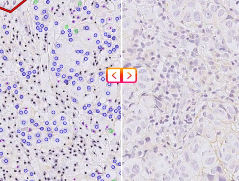 Ibex's, Ibex Breast HER2 is available in Pathflow