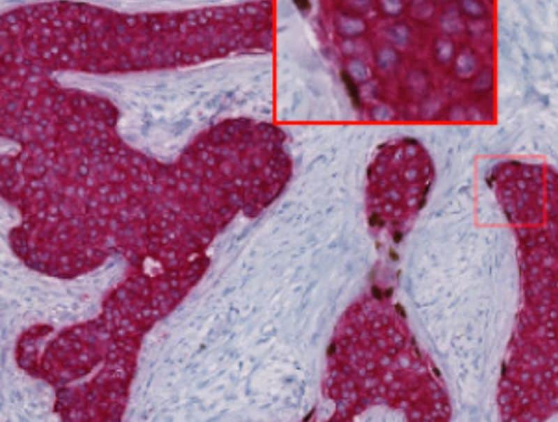 VisioPharm's Invasive Tumor Detection (PDS), is available in Pathflow