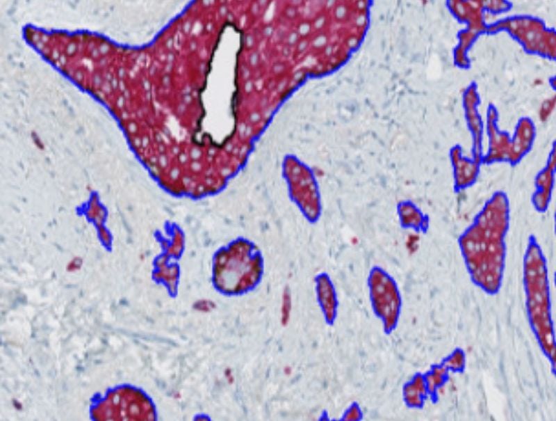 VisioPharm's Invasive Tumor Detection (PDS), is available in Pathflow