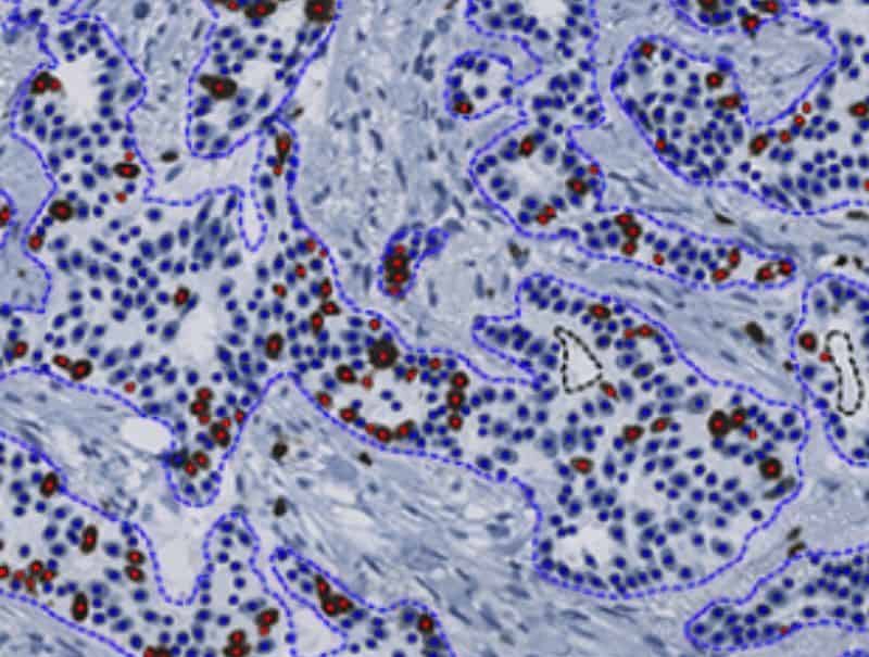 VisioPharm's Ki-67 APP, Breast Cancer is available for Pathflow