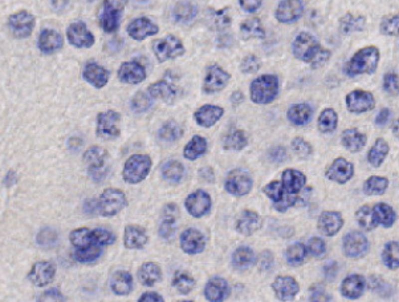 VisioPharm's Ki-67 Neuroendocrine Neoplasm is available in Pathflow