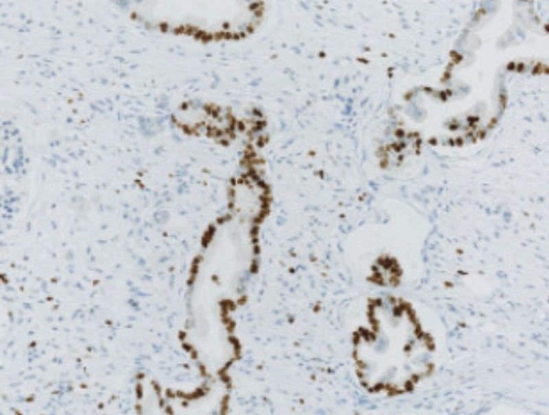 VisioPharm's, Ki-67, Pancreatic Cancer is available in Pathflow