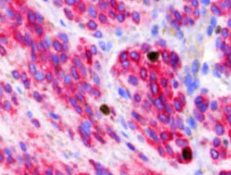 VisioPharm's Ki-67+MART1, Melanoma is available in Pathflow