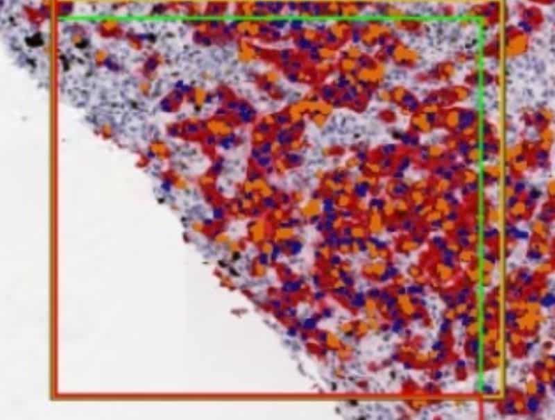 VisioPharm's Ki-67+PanCK, Breast Cancer is available for Pathflow.