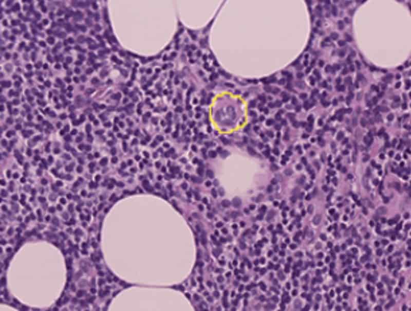 VisioPharm's Metastasis Detection, AI is available in Pathflow