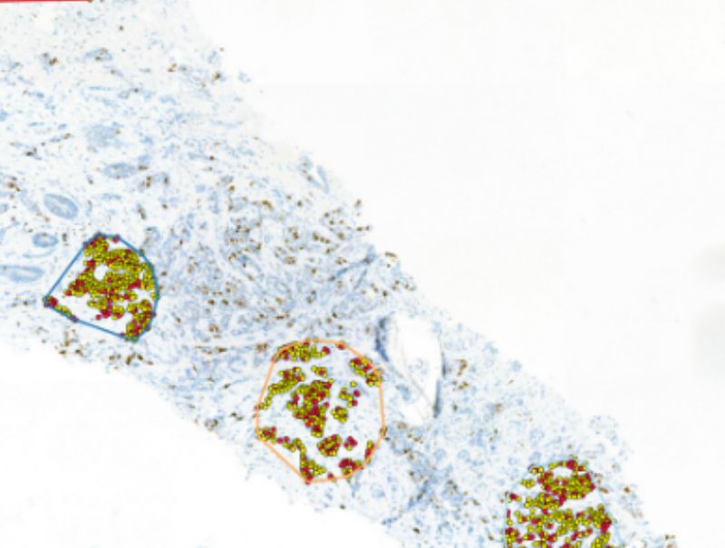 MindPeak's Breast Ki-67 HS is available in PathFlow.