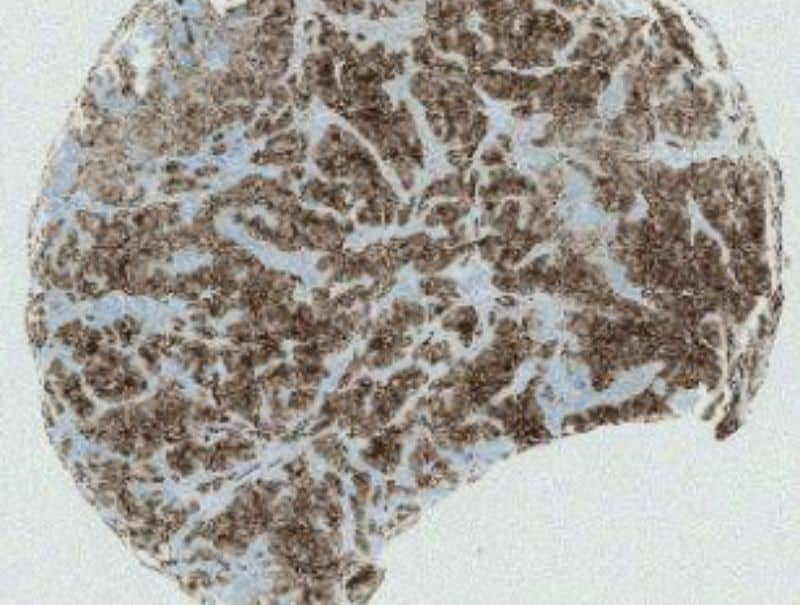 VisioPharm's PCK VDS, Tumor Detection is available in Pathflow