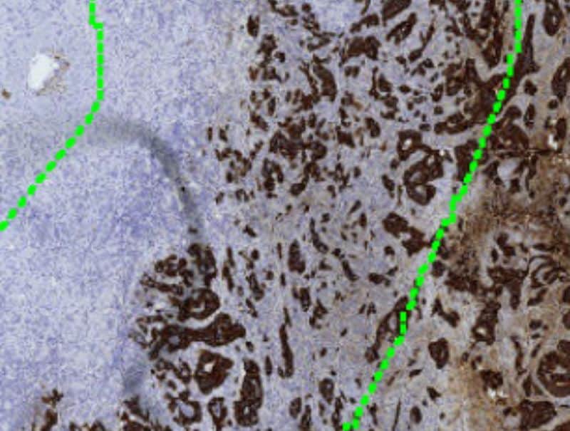 VisioPharm's PCK, Tumor Budding Colorectal Cancer, is available in Pathflow