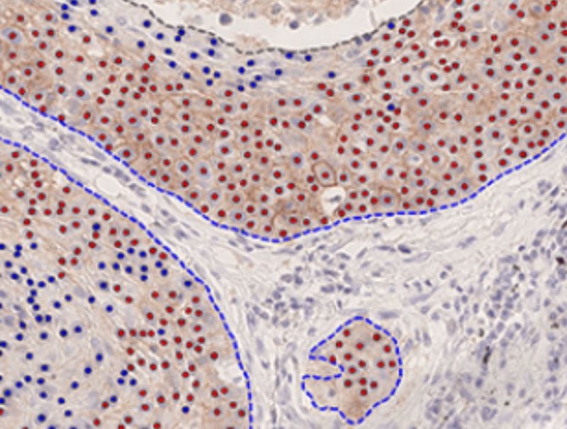 VisioPharm's PD-L1 APP, NSCLC is available in Pathflow