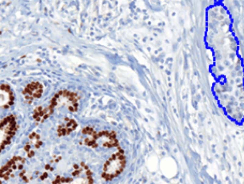 VisioPharm's PR, Breast Cancer, AI is available in Pathflow