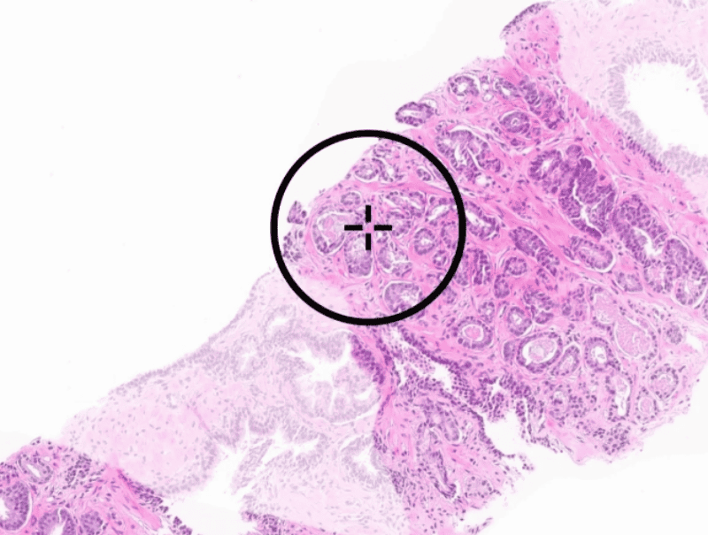 Paige.ai's Paige Prostate is available in Pathflow