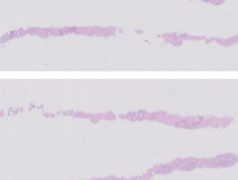 VisioPharm's Prostate Cancer Detection, AI is available in Pathflow