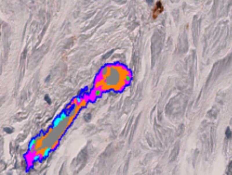 VisioPharm's aSMA+Col IV, Breast Cancer, is available in Pathflow