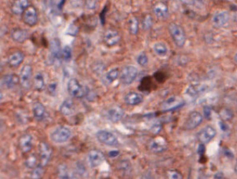 VisioPharm's iNOS, Melanoma, TME is available in Pathflow